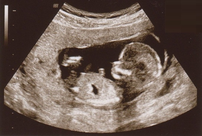 Ultralyd gravid